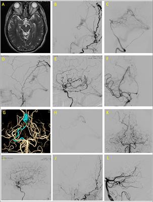 Endovascular Treatment of Medial Tentorial Dural Arteriovenous Fistula Through the Dural Branch of the Pial Artery